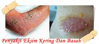 Illustration for article titled area pantang sering gatal dan berair sakit apa ?